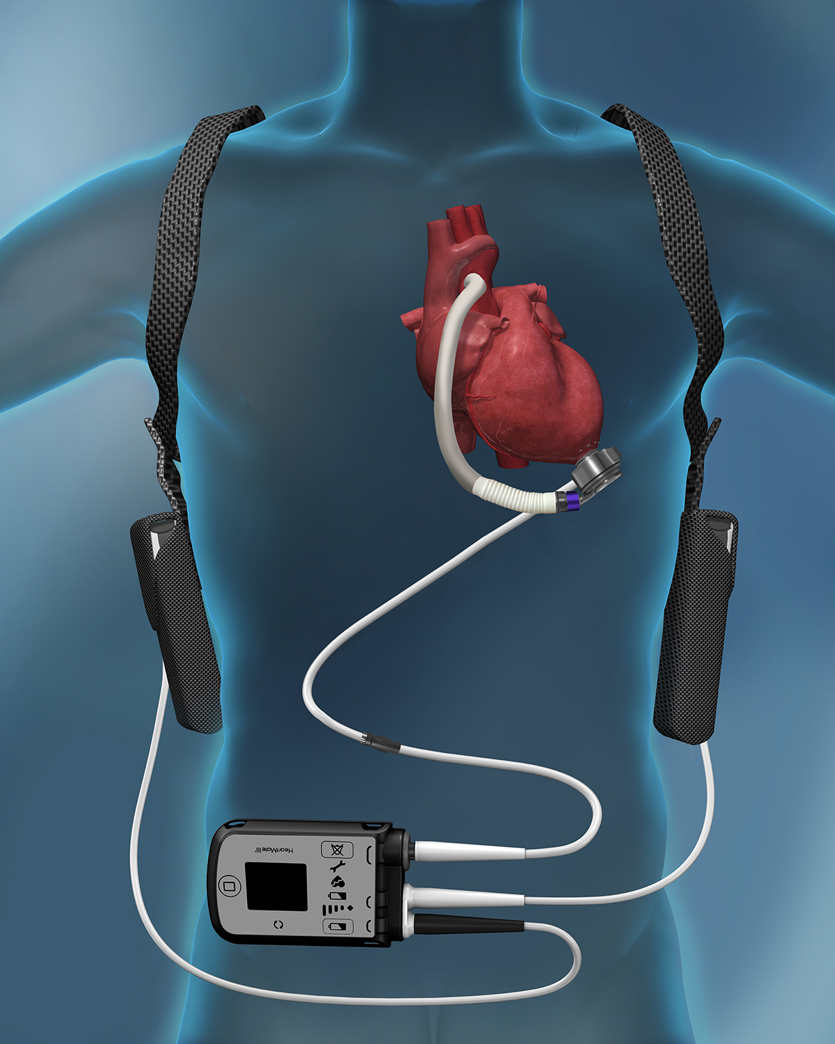 Ventricular Assist Device (VAD) LVAD Implant New Jersey